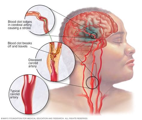 Stroke Symptoms And Causes Mayo Clinic