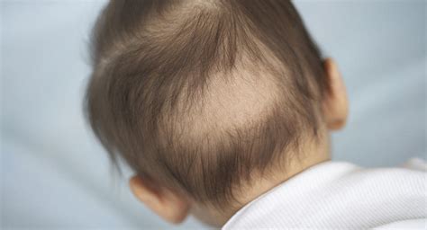 Hair Loss In Babies Babycenter