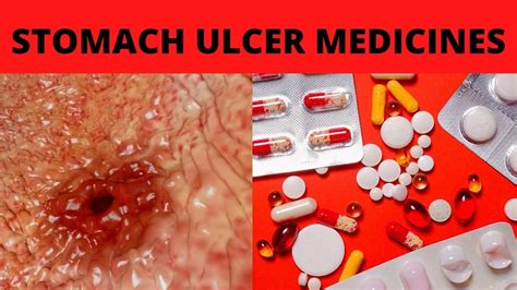 Stomach Ulcer Best Medicine Stomach Ulcer Medicine Stomach Ulcer