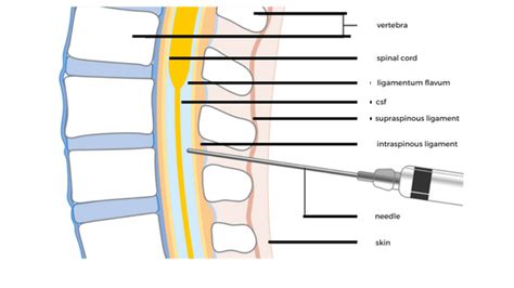 Lumbar Puncture Needle Depth