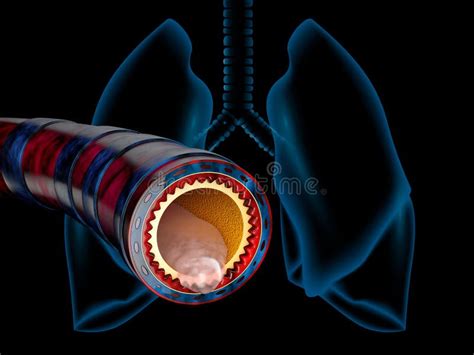 Bronchitis Anatomy Mucus Secreted As A Chest Cold As A D Illustration