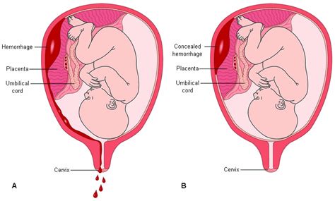 Placental Abruption Symptoms Diagnosis And Treatment BMJ Best Practice