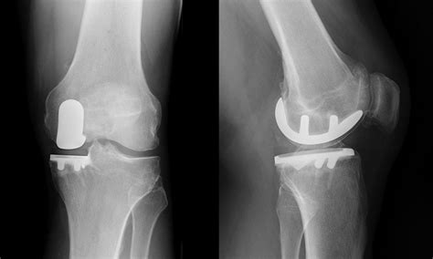 Unicompartmental Or Partial Knee Replacement Proliance Orthopedic