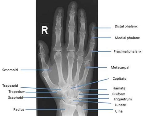 Standard Ap X Ray Of The Hand And Wrist With Labels Naming The Bones
