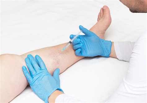 Doctor Performs Sclerotherapy For Varicose Veins On The Legs Varicose