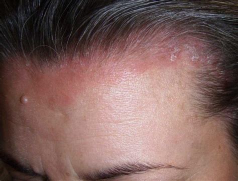 Mild Scalp Psoriasis Pictures Symptoms And Pictures