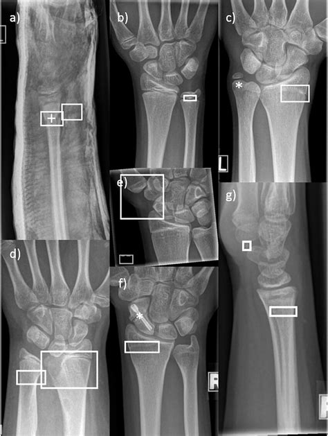 Different Cases Of Erroneously Annotated Fractures In Pediatric Wrist