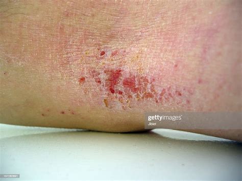 Eczema Nahaufnahme Stock Foto Getty Images