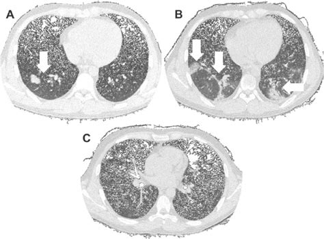 Chest Ct Scan Images A Bilateral And Diffuse Lower Lung With