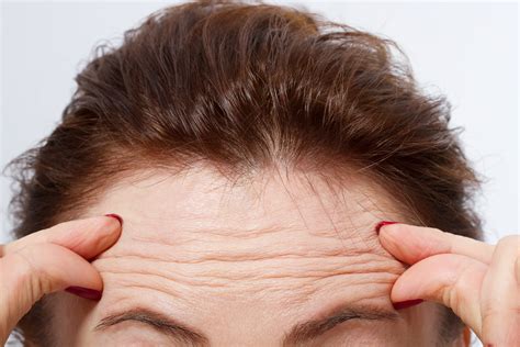 Forehead Wrinkles How To Get Rid Of Them