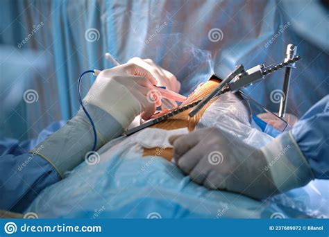 Team Of Professional Doctors Operating A Patient Conducting Open Cut