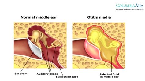 What Are Causes And Symptoms Of Serous Otitis Media Dr Debasish Ent