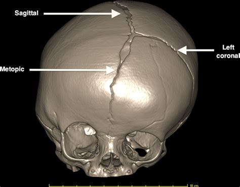 Imaging In Craniosynostosis Archives Of Disease In Childhood