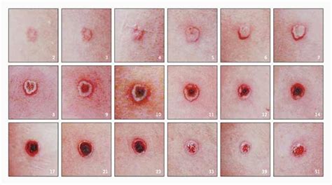 Progression Of The Lesion At The Site Of Inoculation After Smallpox