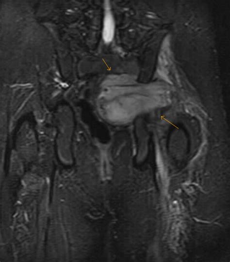 Sciatic Schwannoma Mri Sumers Radiology Blog