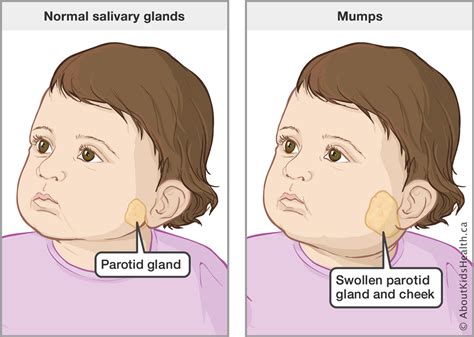 Parotid Gland Swelling Symptoms Pictures Causes Treatment 2018 Images