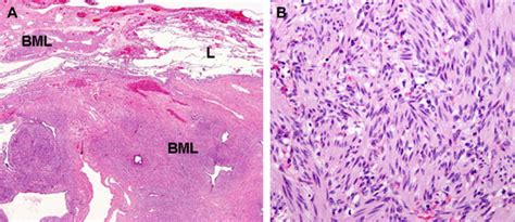 Uterine Smooth Muscle Tumors With Unusual Growth Patterns Journal Of