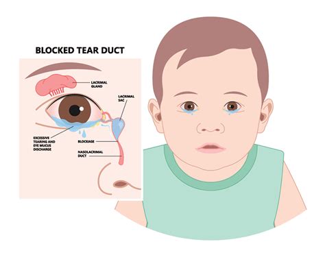 Tear Duct Obstruction Bartlett Pediatric Eye Exam Wheaton Il