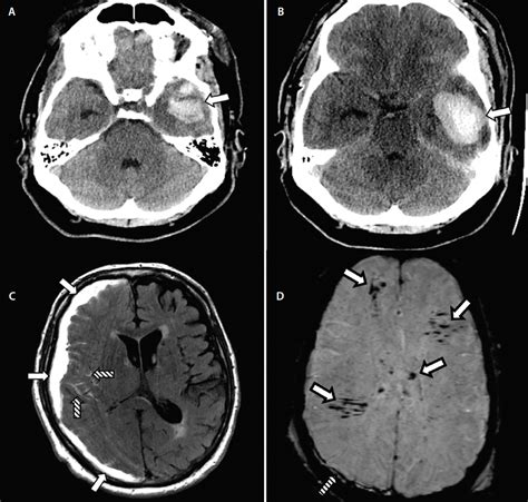 Neuroimaging Traumatic Brain Injuries Practical Neurology