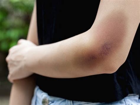 What Doctors Wish You Knew About Bruising Easily Readers Digest