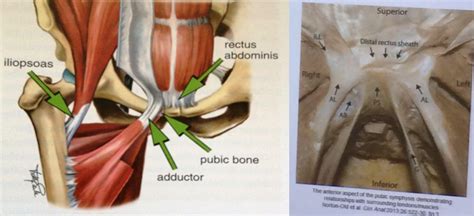 This seems reasonable at first glance because it's well known. Groin pain, treatment and terminology - by Sam Blanchard | RunningPhysio