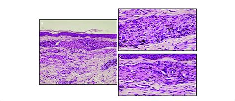 A The Skin Biopsy Shows A Sarcoidal Granulomatous Dermatitis Within