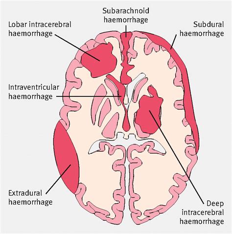 Brain Hemorrhage Intracranial Hemorrhage Subarachnoid Hemorrhage