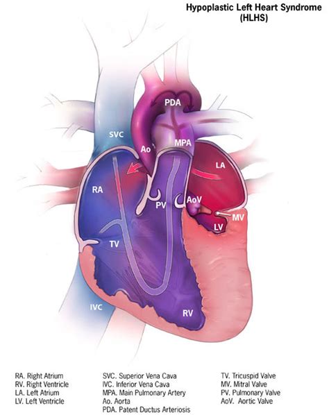 Pda is an acronym, abbreviation or slang word that is explained above where the pda definition is given. Hypoplastic left heart syndrome - Wikiwand