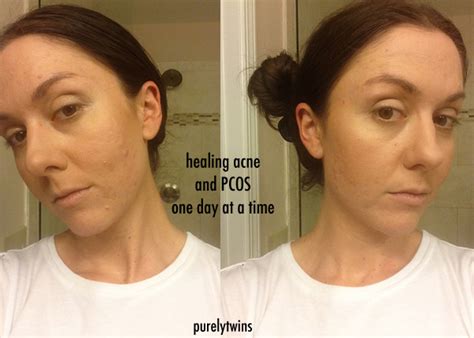 Pcos Acne Journey Continuedsupplements And Products That Help