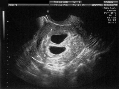 Normal Uterus Transvaginal Ultrasound