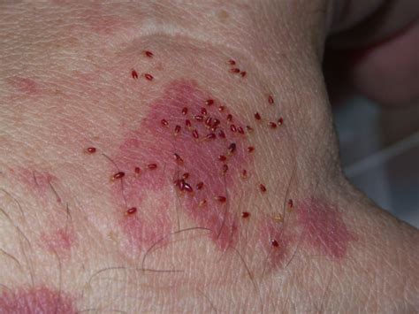 Injury Bed Bug Bites How Are Bed Bug Bites Images And Data