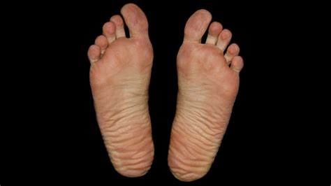 Between the three middle toes on my right foot and the ball of my foot, i experience a lump as if my sock were balled up behind my toes. What Is A Ganglion Cyst Of The Foot & What Can You Do ...