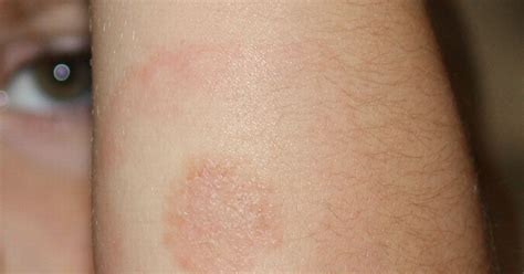 Lyme Disease Rash In Children
