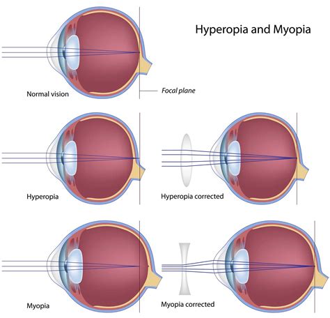 Farsighted Hyperopia Petrou Eye Care