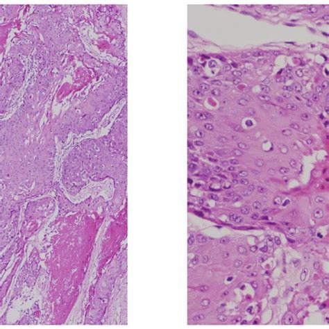 Histopathological Findings Of The Resected Specimens Revealed Squamous