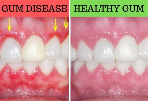 Fight And Reverse Periodontal Gum Disease 9to5hacks