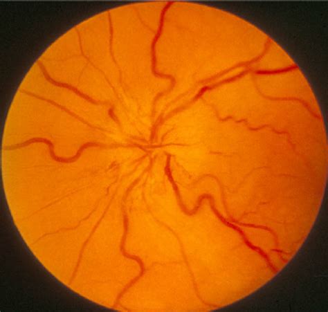 Left Fundus Photograph Showing Optic Disc Edema And Hyperemia During