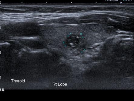 Thyroid Nodule Radiology Reference Article Radiopaedia Org