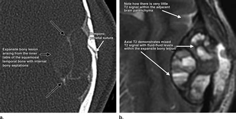 Aneurysmal Bone Cyst A Axial Ct Image Shows An Expansile Bone Lesion