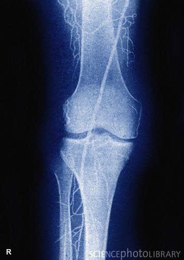 Angiogram Of The Right Leg Revealing Thromboangiitis Obliterans