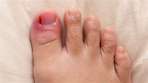 Ingrown Toenails On The Rise In Lockdown How To Get It Sorted