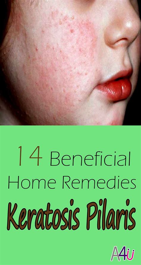 14 Beneficial Home Remedies To Get Rid Of Keratosis Pilaris Keratosis