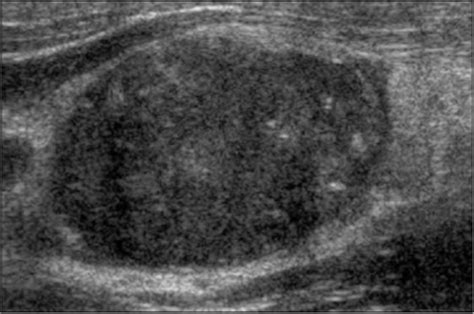 Papillary Thyroid Cancer Ultrasound Colors Bornmodernbaby