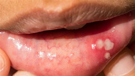 Canker Sores Causes Symptoms And Treatment Options