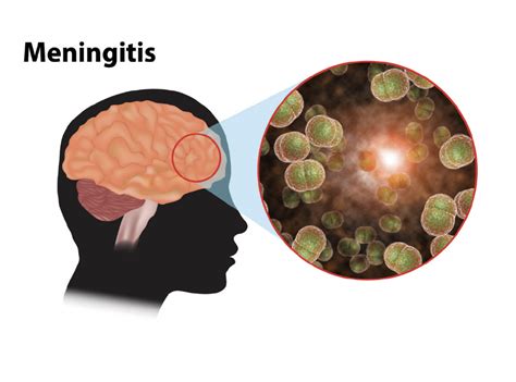 Meningitis Research Foundation • Scientiaglobal