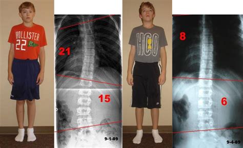 Scoliosis Austin Chiropractor Dr Daniel Gonzalez Discusses Scoliosis Causes Symptoms And