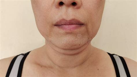 The Flabby And Sagging Skin Under The Neck Wrinkles And Cellulite