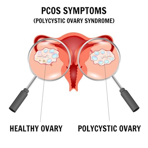 premium vector pcos symptoms polycystic ovary syndrome gynecology disease infographic in