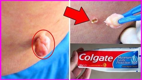 How to care for your child's skin post treatment. HOW TO REMOVE SKIN TAG IN 1 NIGHT OF APPLYING TOOTHPASTE ...