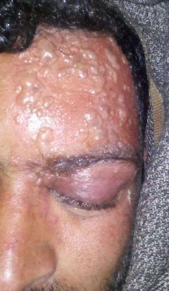 Have systemic antivirals made a herpes zoster ophthalmicus natural history, risk factors, clinical presentation, and morbidity. Doctors' Hub: What is Herpes Zoster Ophthalmicus?